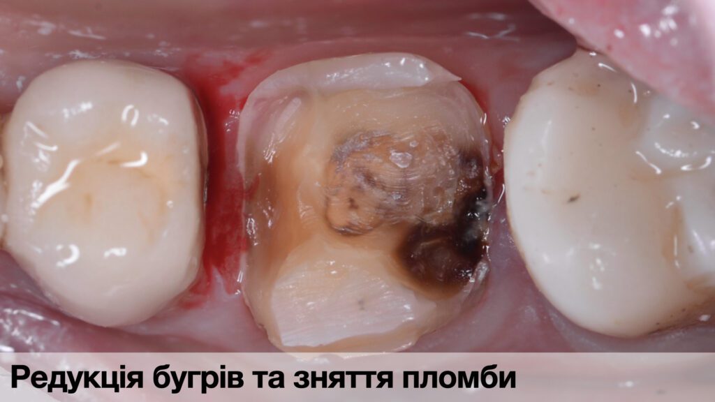 _Кейси по адгезиї._004