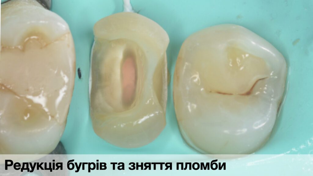 _Кейси по адгезиї._011