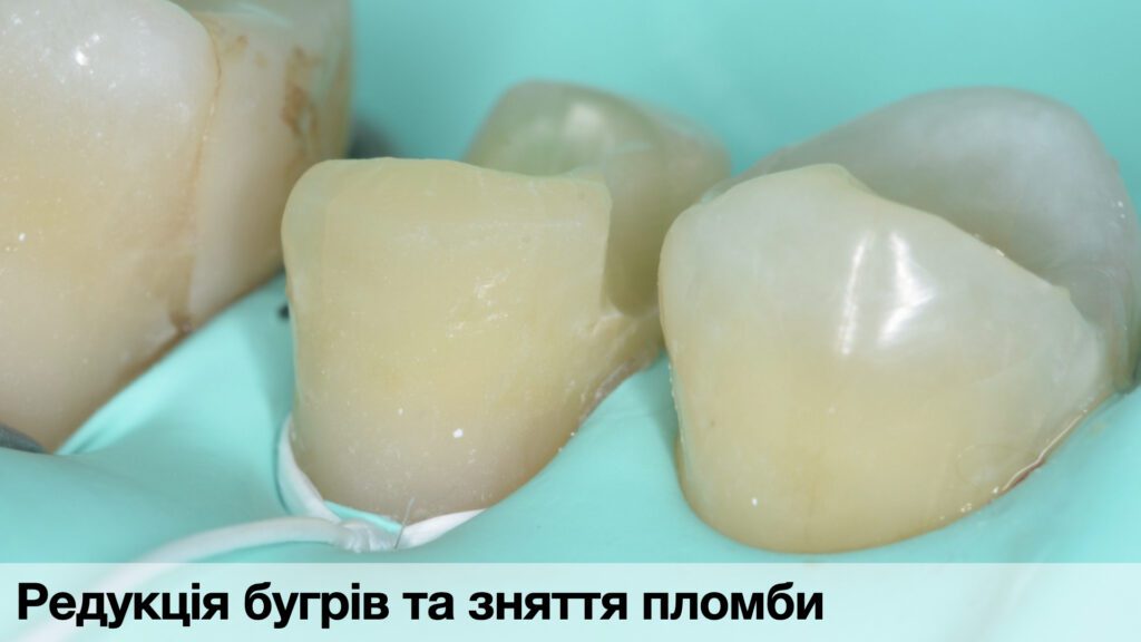 _Кейси по адгезиї._012