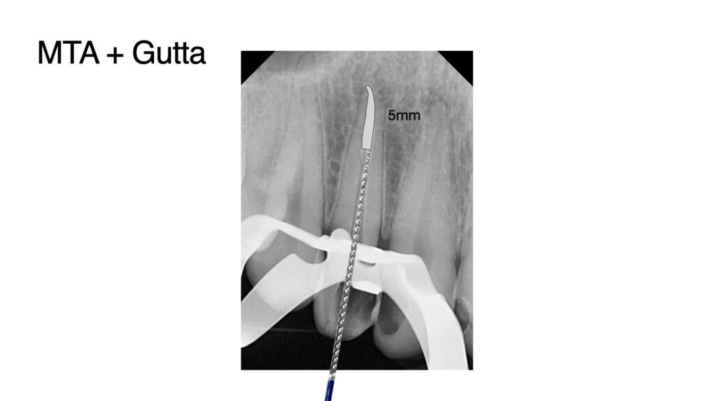 Apical plug.0601