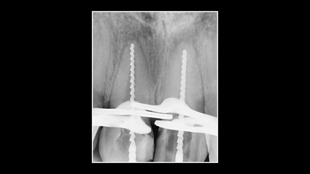 Apical plug11.001