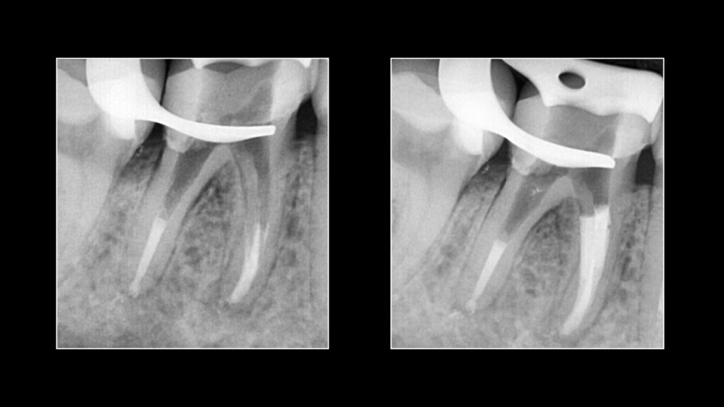 Apical plug6.0601