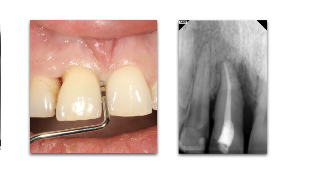 endo perio.001